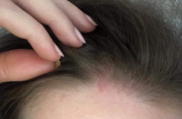 Môže byť toto psoriáza?