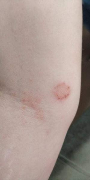 Aké sú toto vyrážky?