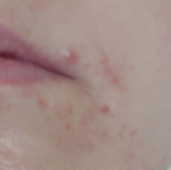 Môže to byť pásový opar?