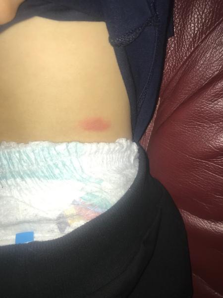 Červené fľaky na nohách u dvojročného dieťaťa