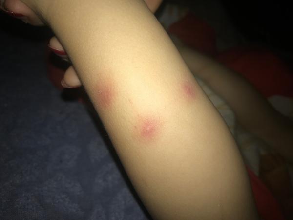 Červené fľaky na nohách u dvojročného dieťaťa