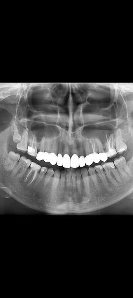 Kto vie zhodnotiť tento zubný RTG?