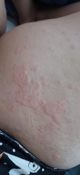 Čo sa mi objavilo na stehnách?