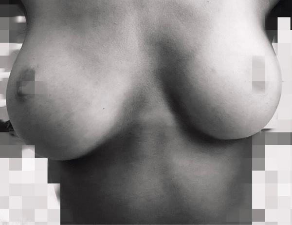 Ako riešiť asymetriu a vpuklé bradavky?