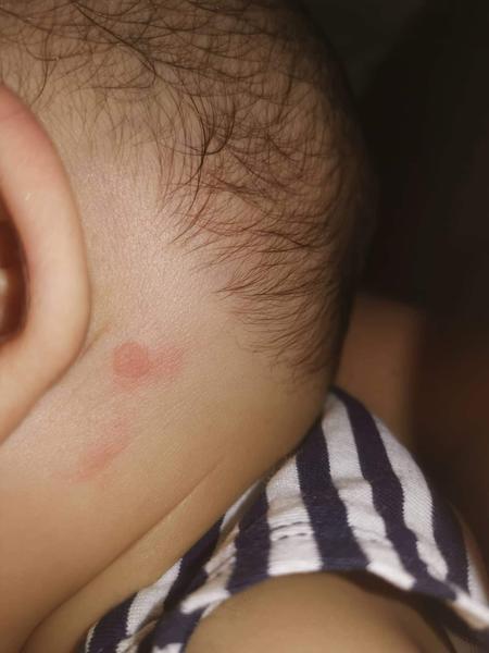 Začervenané miesto - ekzém