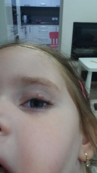 Pod hrčou trojročnej dcérke nerastú mihalnice. Ako máme postupovať?