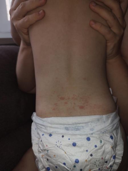 Sú to začínajúce kiahne?