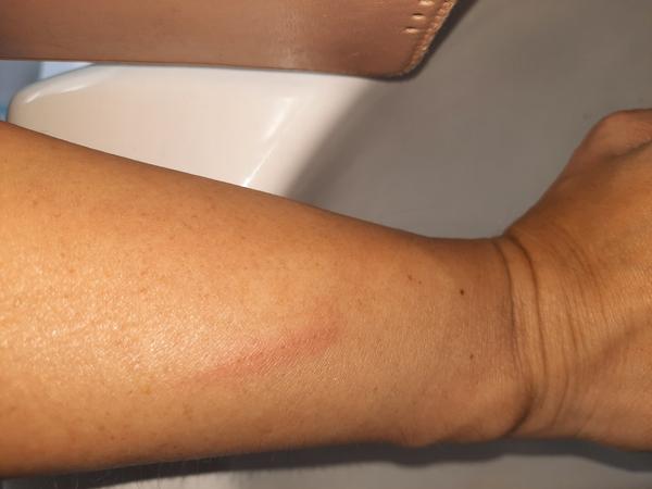 Tetanus vakcína - poškriabanie sa hrdzavým závitom