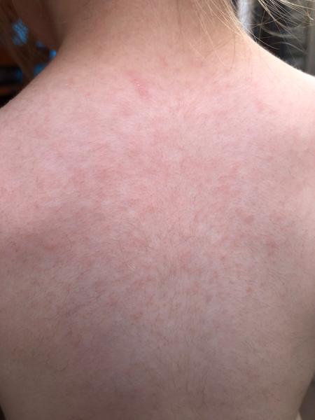 Vyrážky alebo výsev u 3-ročnej