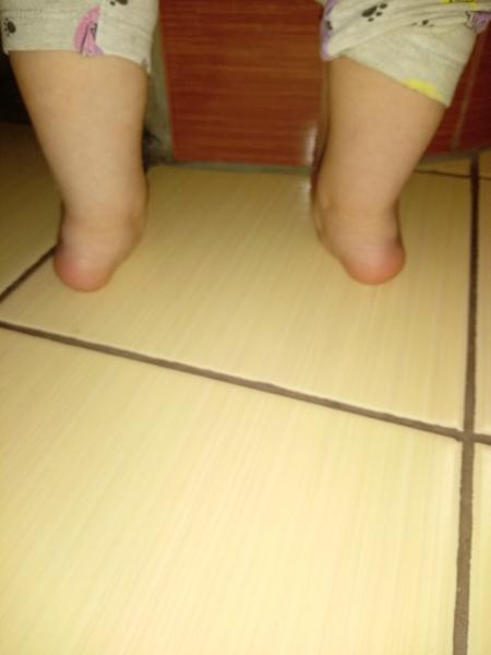 Má naša dvojročná dcérka iba ploché nohy?