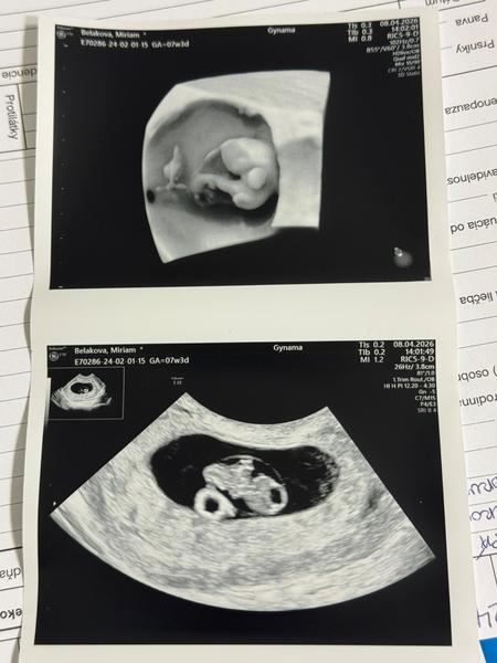 Prvý ultrazvuk: Možné určenie pohlavia dieťaťa?