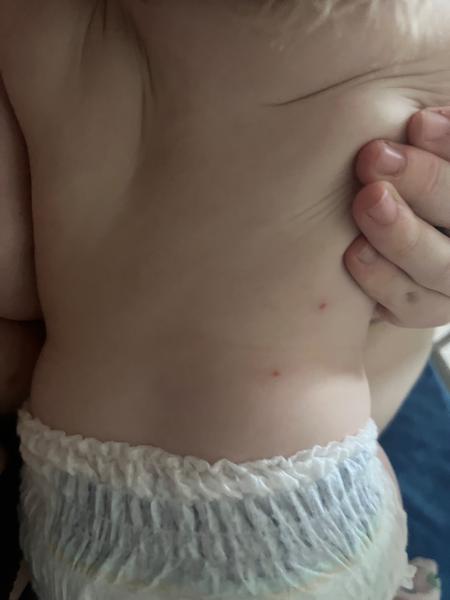 Pupáčiky na chrbte dieťaťa: Potrebujem radu mamičiek