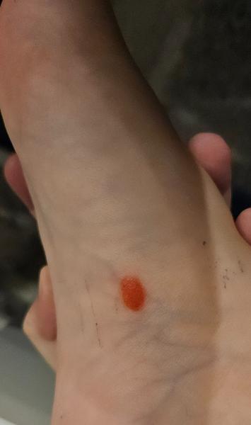 Jasnočervený fľak na chodidle dieťaťa