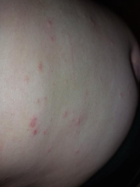 Akú to mám vyrážku?