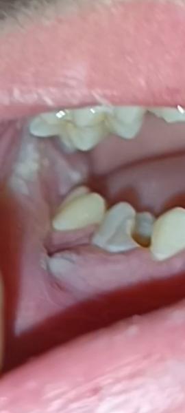 Ako liečiť bolestivé miesto na ďasnách, ktoré nezmizne?