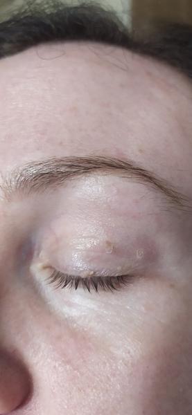 Dá sa odstrániť fibróm z viečka?