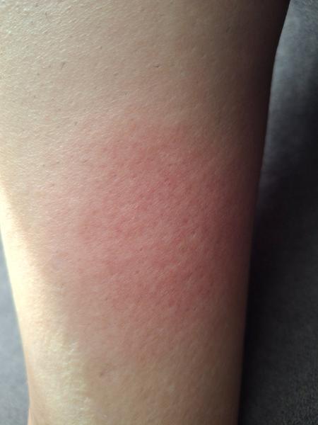 Bolestivý  fľak na lýtku