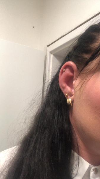 Ako liečiť zapálené ucho po piercingu?

