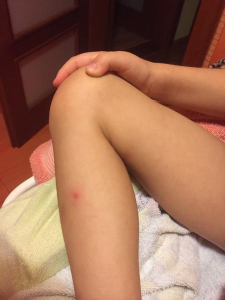 Vyrážky- prosím, viete mi poradiť čo je mojej malej?