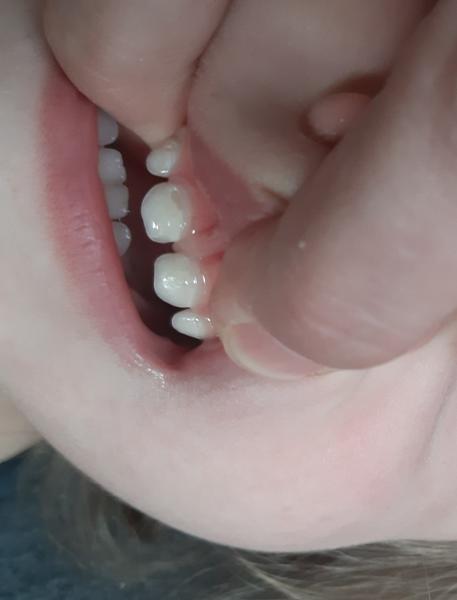 Čo to má dcérka na zúbkoch?