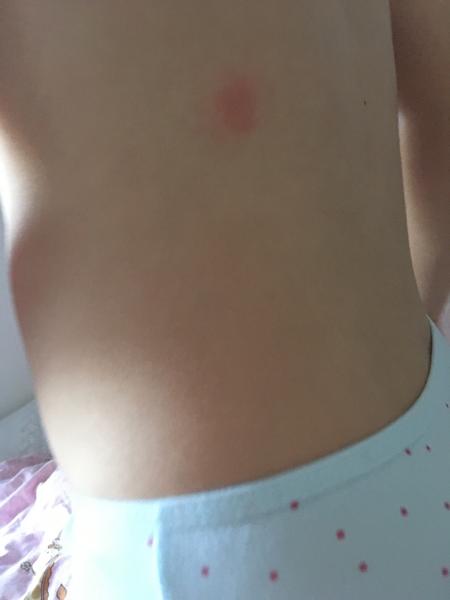 Aké štípance to má moja štvorročná dcéra po tele?