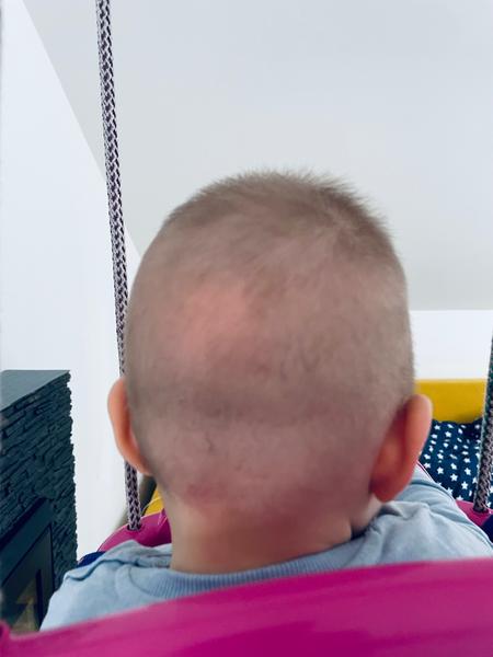 Ako postupovať, keď 9 mesačné dieťa má asymetrickú hlavu?