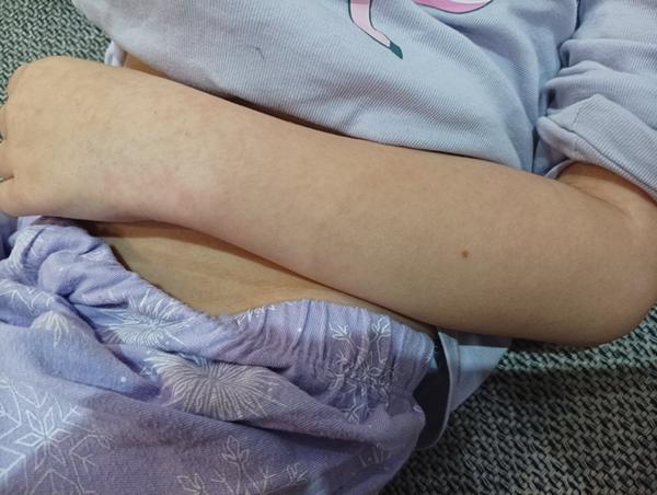 Čo spôsobuje fľaky na bruchu a hrudníku?