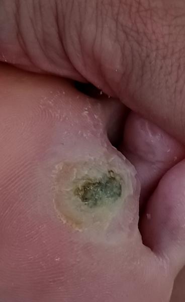 Bradavice verzus kurie oko