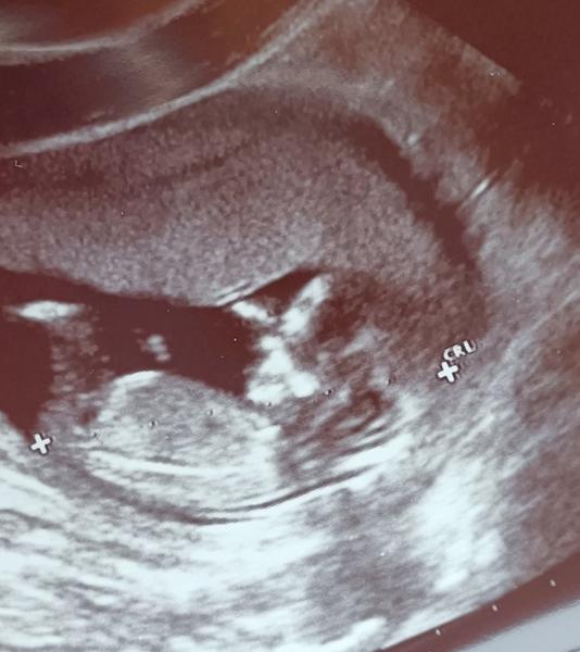 Je na fotke zo sona vidieť pohlavie?