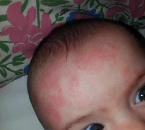 Suché vyrážky a fliačiky na tvári