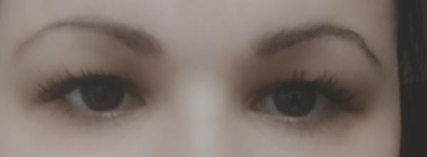 Pomohol by mojim horným viečkam fibroblast?