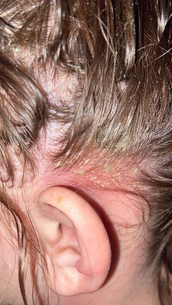 Silný zápal lyfatickej uzliny