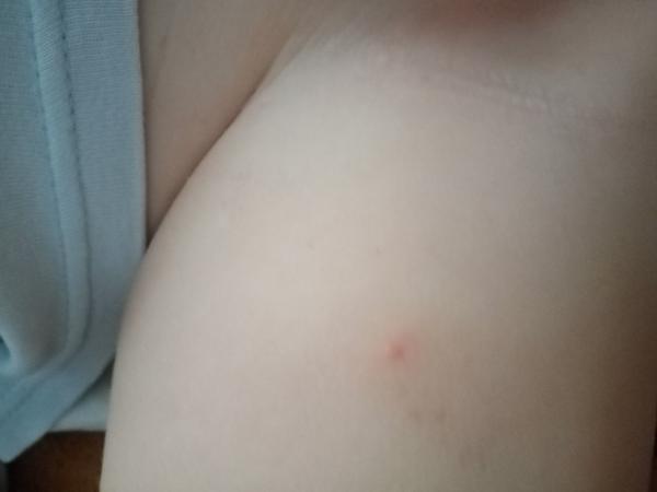 Má moje dieťa kiahne?