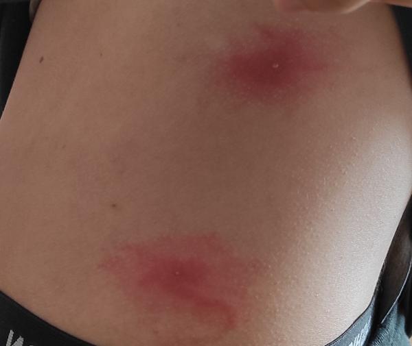 Od čoho sú tieto štípance?