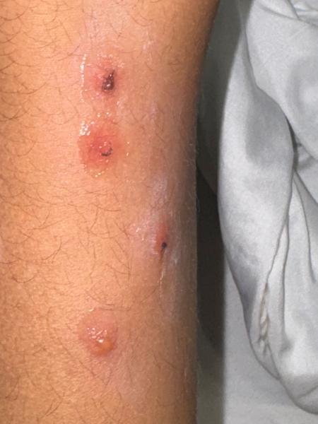 Kedy je potrebná hospitalizácia u detí s impetigom?