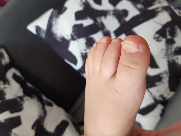 Má moja dcéra pľuzgier na nohe?