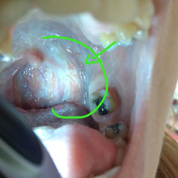 Aké pľuzgieriky mám v oblasti mandlí?