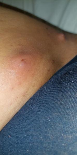 Čo to mám na stehne?