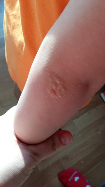 Aký kožný problém má moje dieťa na lakti?