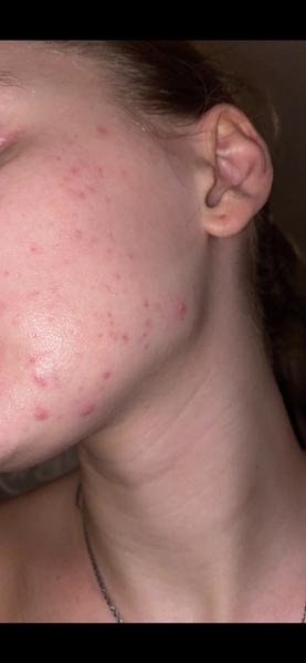 Čo vám pomohlo na akné?