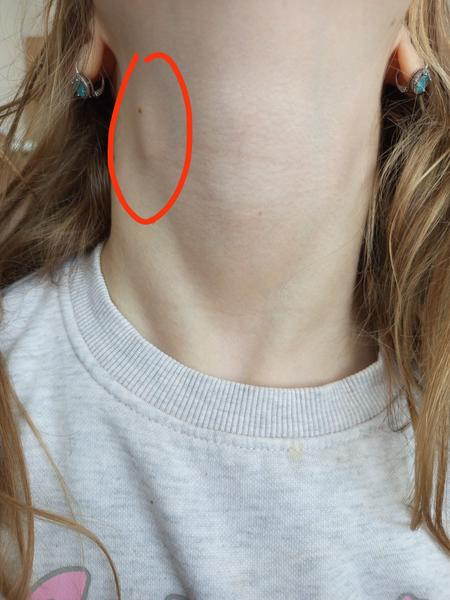 Uzlina na krku u dcérky