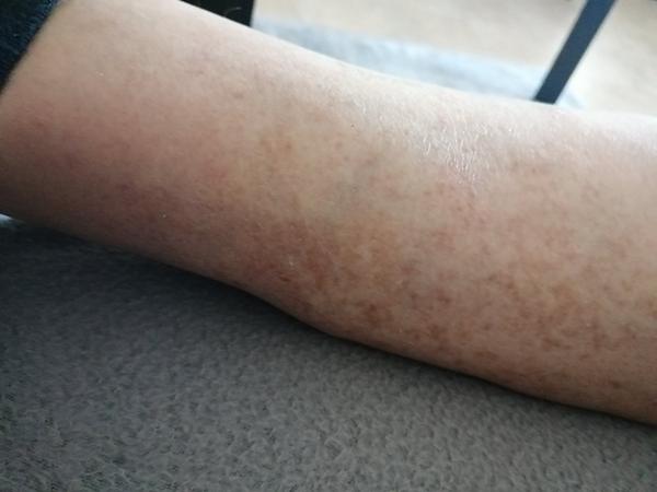 Fľaky na nohách: čo to môže byť?