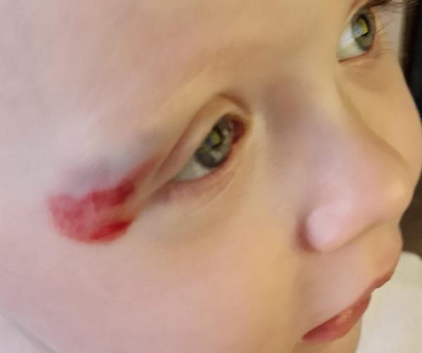 Ako zmierniť hematóm v okolí očka?