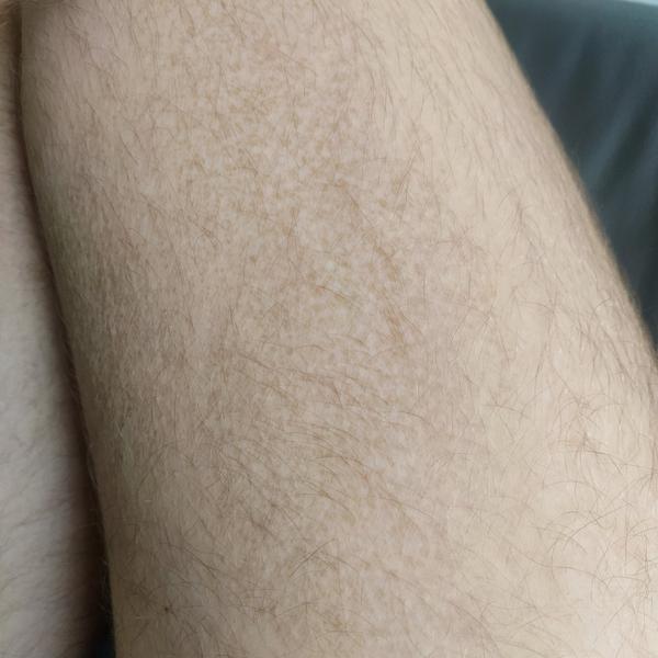 Kožná choroba u 15-ročného