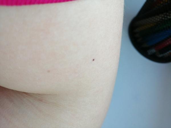 Aký je Váš názor na moje čierne znamienko?