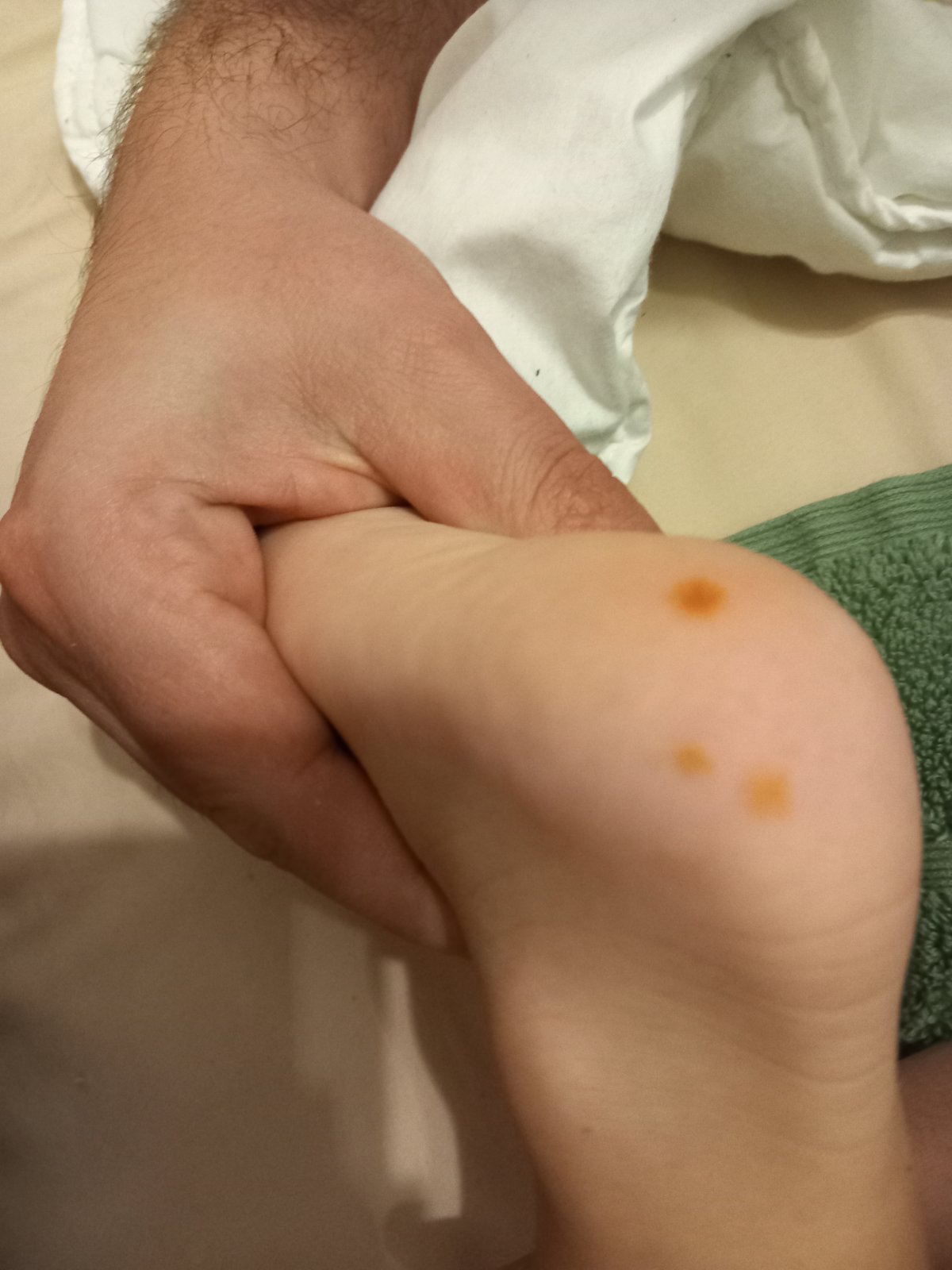 Môže súvisieť hnedé fľaky na chodidle so salmonelózou?