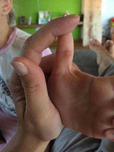 Môže mať 5 ročné dieťa kurie oko na palčeku?