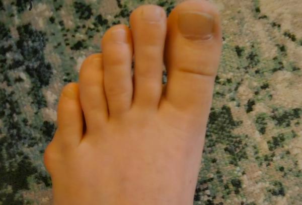 Skúsenosti s bolesťou a opuchom na chodidle