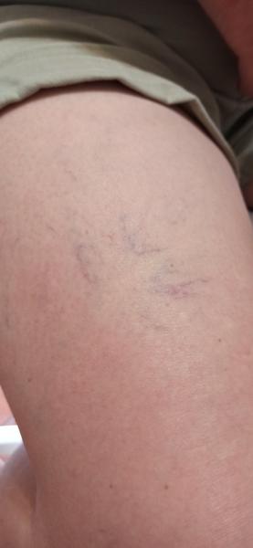 Žily na nohe u skoro 60-ročnej