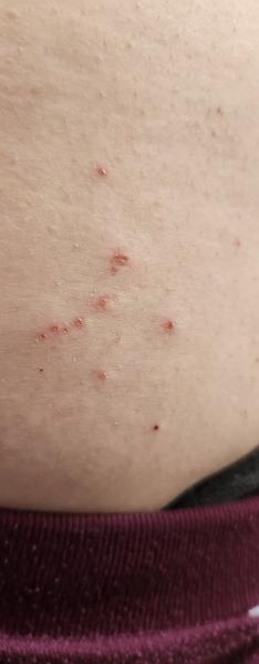 Prečo sa mi objavili tieto vyrážky?